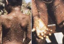 Ska asnjë rast të konfirmuar me Linë e Majmunit në Maqedoni