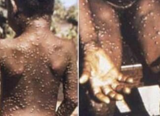 Ska asnjë rast të konfirmuar me Linë e Majmunit në Maqedoni