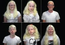 13 qershori – dita botërore e albinizmit