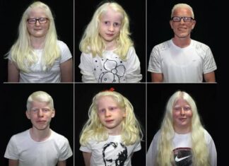 13 qershori – dita botërore e albinizmit