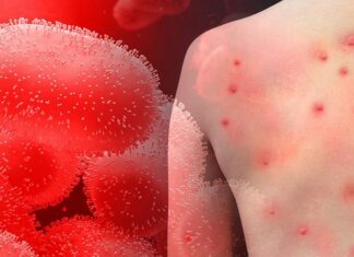 Çfarë është “Lija e majmunit” dhe si mund të merret