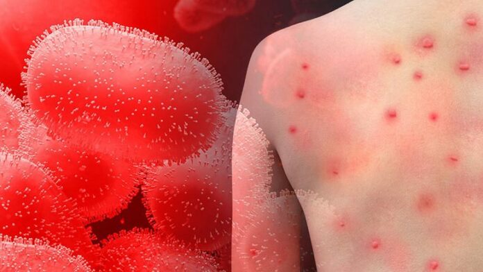 NWLD-composite-monkeypox-MH2-780x439